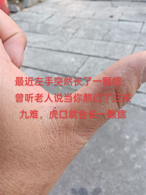 男生左手有痣|左手长痣 左手长痣代表什么